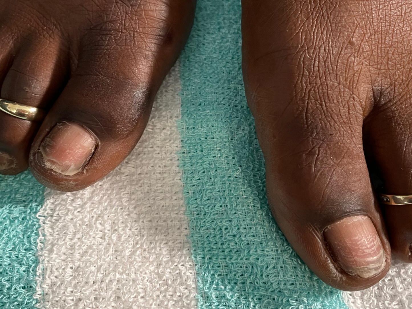Acrylic Toe Nail